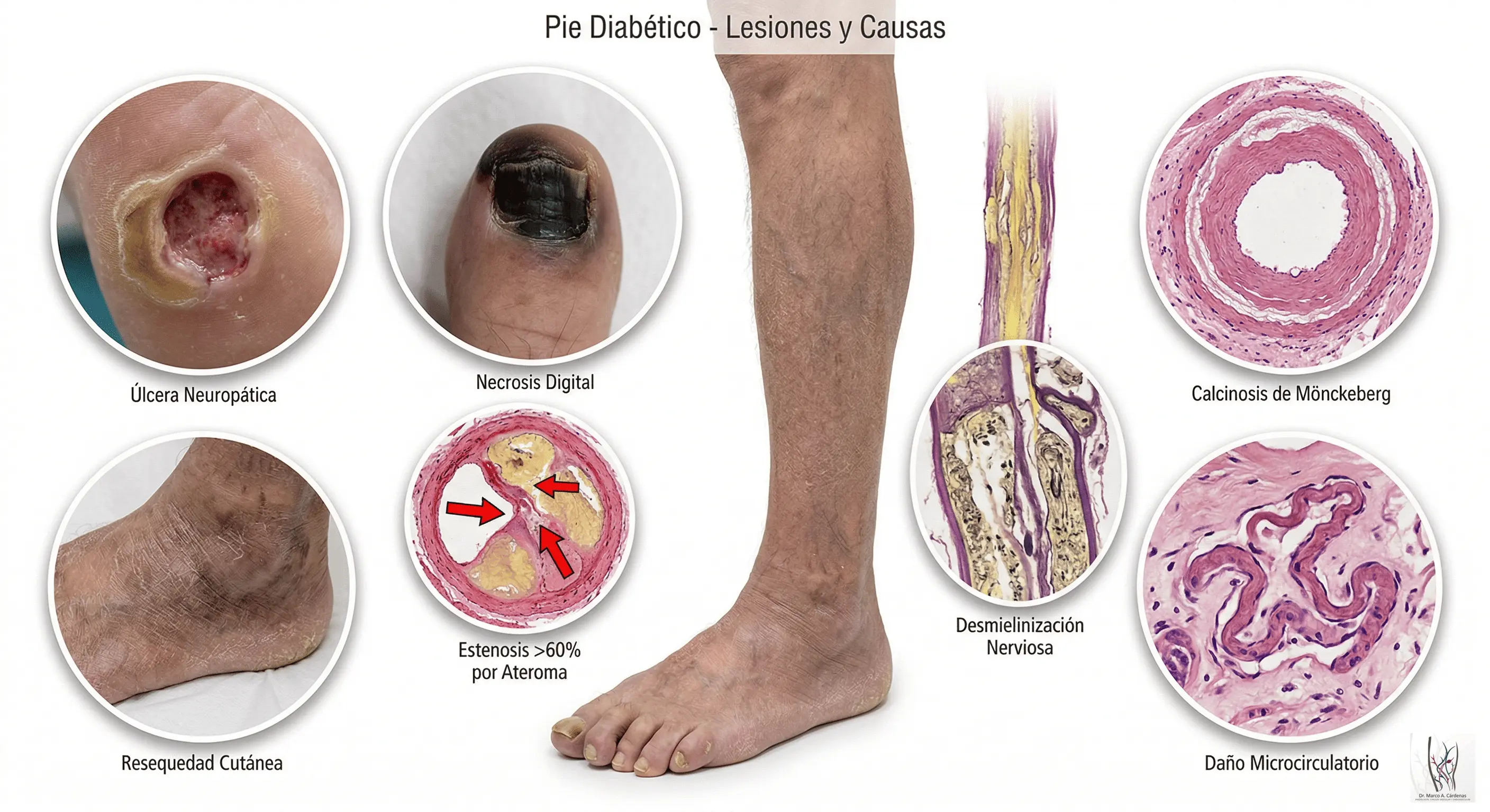 Pie Diabético Complicado